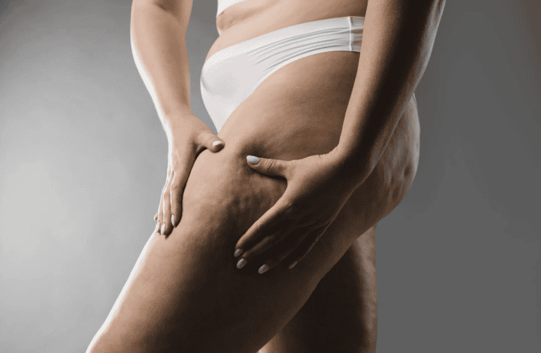 The Role of SOD B Dimpless® in Reducing Stubborn Cellulite